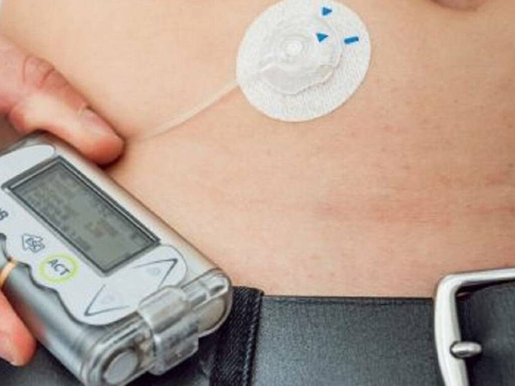 La bimba diabetica può rimettere in funzione il suo microinfusore necessario per iniettare l’insulina in caso di necessità 